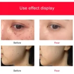 SONGSUN X2 Professional Portable Skin Spot Tattoo Freckle Removal Machine Mole Dot Removing Laser Plasma Beauty Care Pen with LCD Display Screen & 9 Gears Adjustment - Image 8