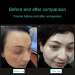 Handheld Picosecond Portable (Removing Tattoo Freckle Mole Dot) Machine Laser Plasma Beauty Care Pen - Image 4