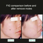 Handheld Picosecond Portable (Removing Tattoo Freckle Mole Dot) Machine Laser Plasma Beauty Care Pen - Image 6