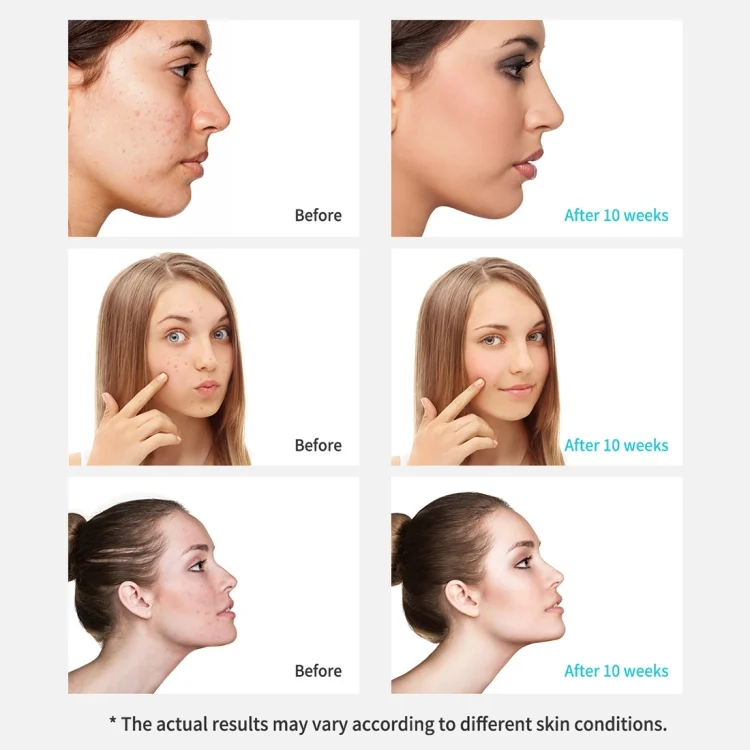 HCB0776_10.webp Xpreen Rechargeable Pore Cleanser Home Facial Beauty Device with LED Screen & 4 Probes - Image 11