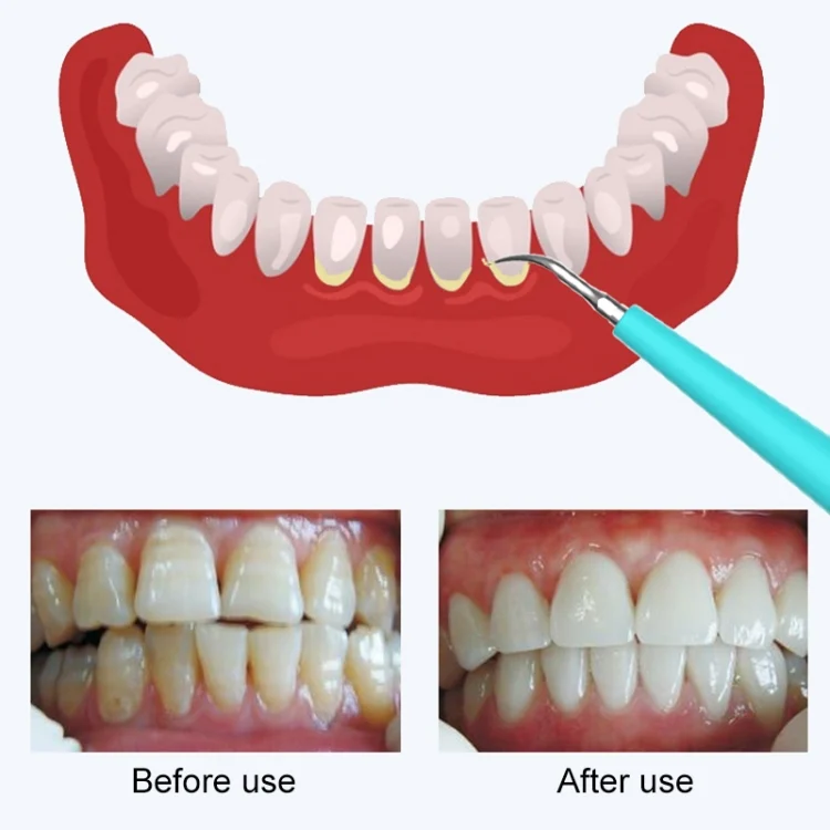 HCB0985F_5.webp LSHOW YJK015A 3.7V USB Charging Five-speed Mode Waterproof Household Electric High-frequency Vibration Teeth Polisher - Image 6