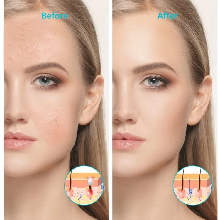 HCB8042W_7.webp XPREEN XPRE052 Wireless Rechargeable Light Acne Treatment Device Home Acne Clearing Eraser with Blue Light and Red Light - Image 8