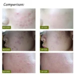 K-SKIN KD-7910 Acne Laser Pen Portable Wrinkle Removal Machine Durable Soft Scar Remover Device Blue Light Therapy Pen - Image 14