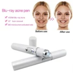 K-SKIN KD-7910 Acne Laser Pen Portable Wrinkle Removal Machine Durable Soft Scar Remover Device Blue Light Therapy Pen - Image 6
