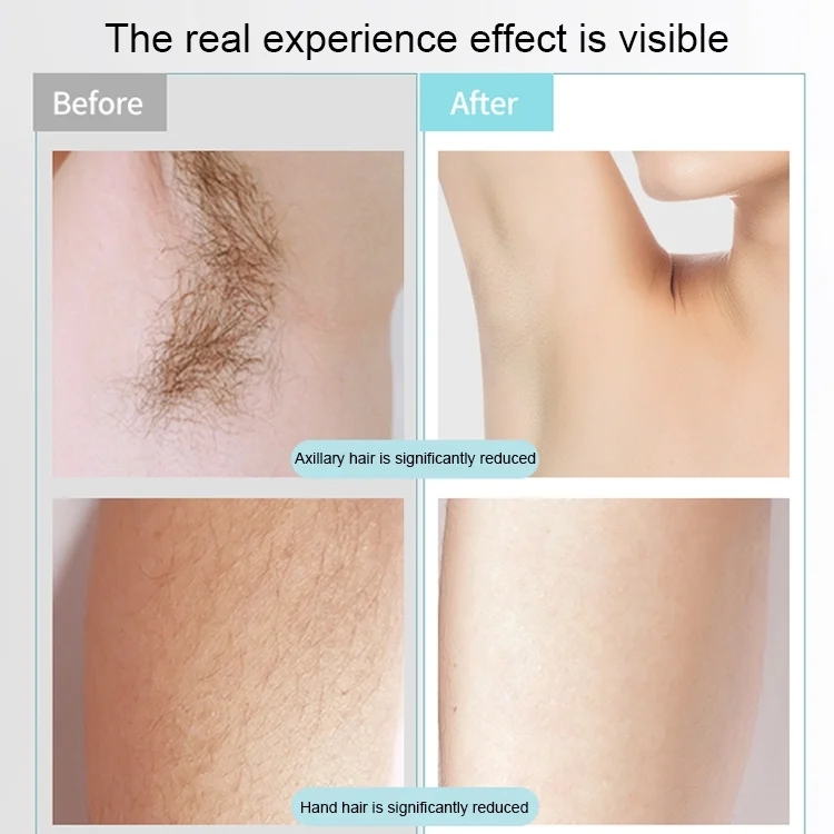 SYA003274_5.webp K_SKIN KD506A Epilator Household Freezing Photon Hair Removal Instrument 5 Levels of Light Intensity for Cheek Armpit Leg Back - Image 6