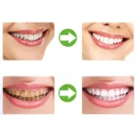 2 PCS Thermoforming Dental Mouthguard Teeth Whitening Trays Oral Care - Image 6