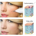 Dark Spot Remover USB Laser Plasma Pen Facial Freckle Wart Removal Beauty Care Device - Image 15