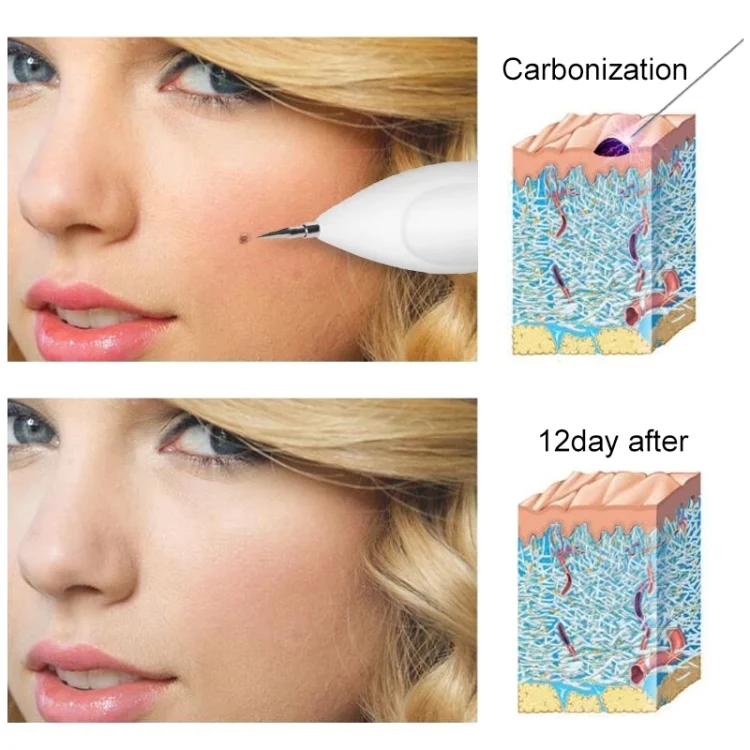 TBD04170071_14.webp Dark Spot Remover USB Laser Plasma Pen Facial Freckle Wart Removal Beauty Care Device - Image 15