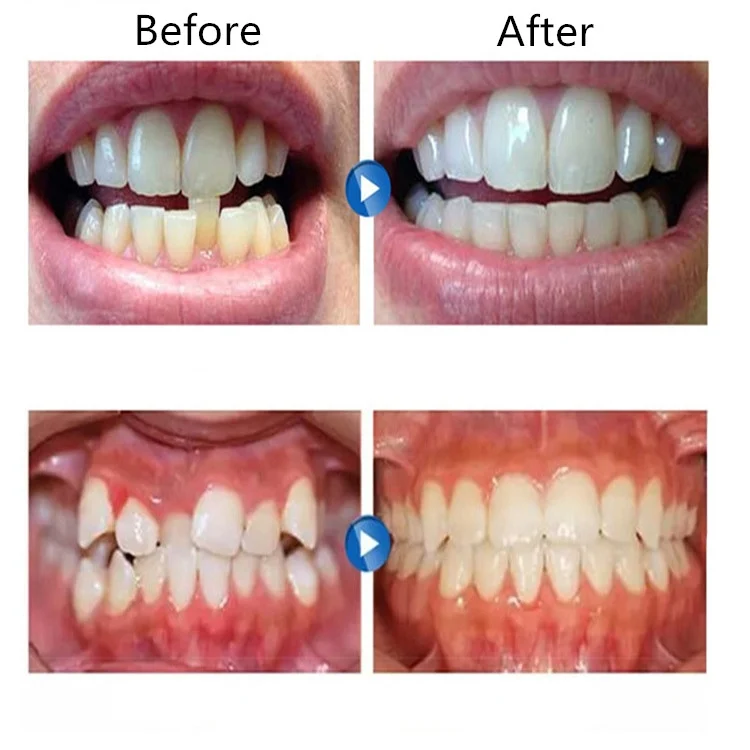 TBD0424263201A_5.webp Orthodontic Appliance Silicone Simulation Braces Anti-molar Braces for Night - Image 6