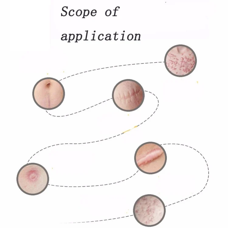 TBD0538637_2.webp Organic silicone Gel Scar Therapy Patch  be Washed and Reused - Image 3