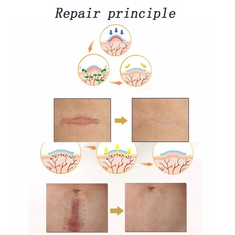 TBD0538637_3.webp Organic silicone Gel Scar Therapy Patch  be Washed and Reused - Image 4