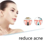 QY208 Facial Cleansing Blackhead Pore Cleaner - Image 5