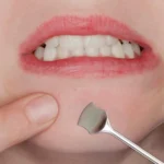 Stainless Steel Pore Cleaning Tool Blackhead Cleaner Beauty Makeup Remover - Image 5