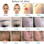 AA-A401 Small Freckle and Mole Removal Pen Tattoo and Eyebrow Removal Beauty Instrument - Image 10
