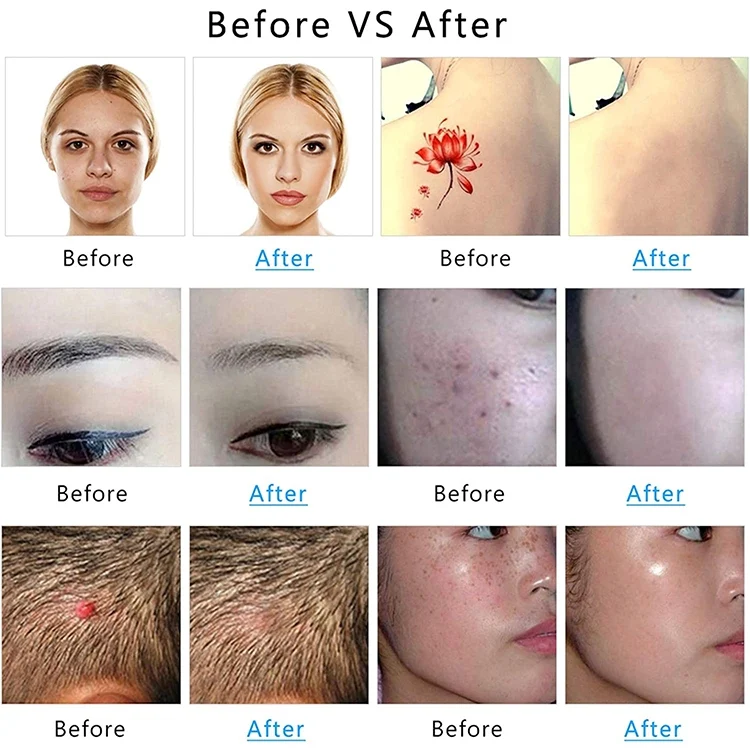 TBD0603542301_B9.webp AA-A401 Small Freckle and Mole Removal Pen Tattoo and Eyebrow Removal Beauty Instrument - Image 10