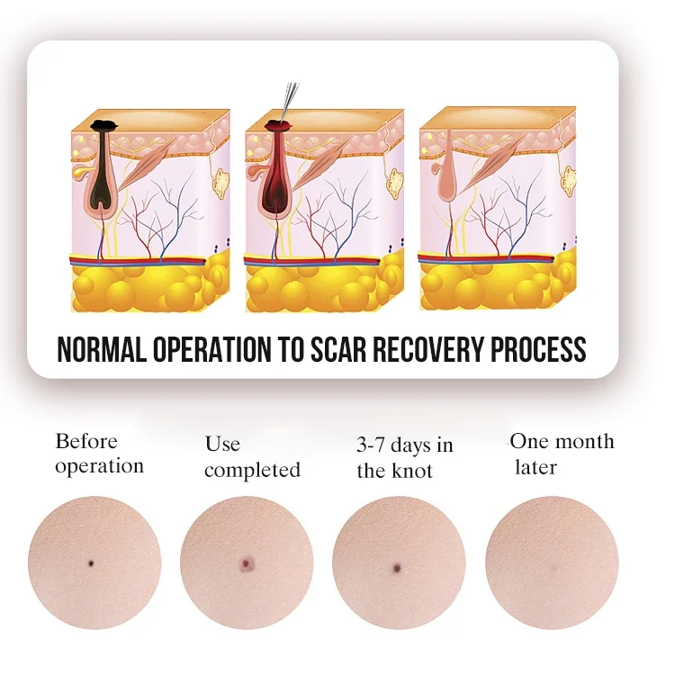 TBD0603543701_B3.webp FY-106 Portable Mole and Freckle Removal Pen Household Laser Beauty Equipment - Image 4