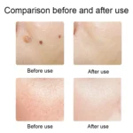 FY-106 Portable Mole and Freckle Removal Pen Household Laser Beauty Equipment - Image 9