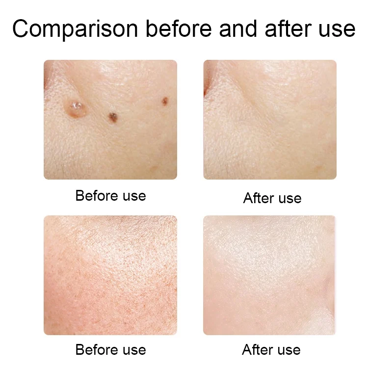 TBD0603543701_B8.webp FY-106 Portable Mole and Freckle Removal Pen Household Laser Beauty Equipment - Image 9