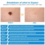 2 IN 1 Auto Skin Tag Remover Device Adult Mole Wart Remover Face Care Beauty Tools - Image 7