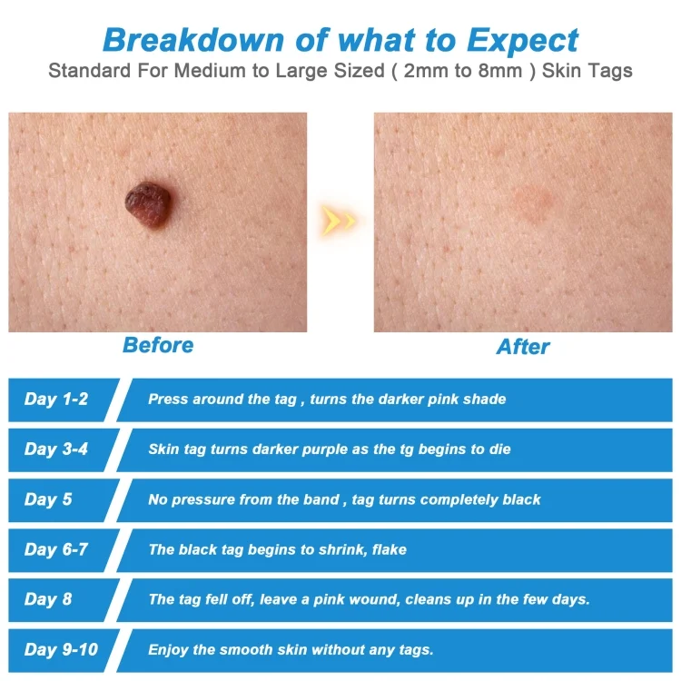 TBD06036083_6.webp 2 IN 1 Auto Skin Tag Remover Device Adult Mole Wart Remover Face Care Beauty Tools - Image 7