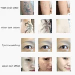 Laser Tattoo Removal Machine Non-invasive Eyebrow Washing Beauty Equipment - Image 8