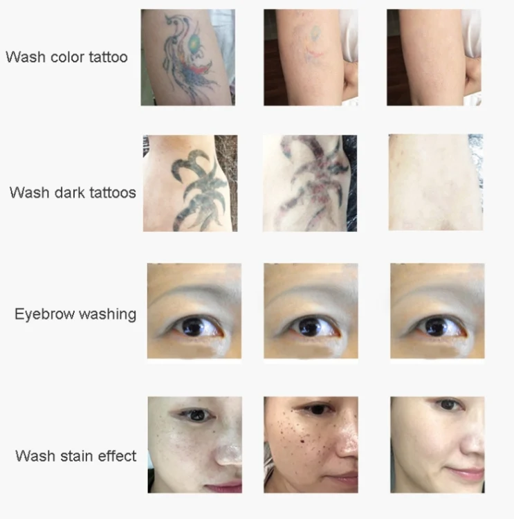 TBD06038955_B7.webp Laser Tattoo Removal Machine Non-invasive Eyebrow Washing Beauty Equipment - Image 8