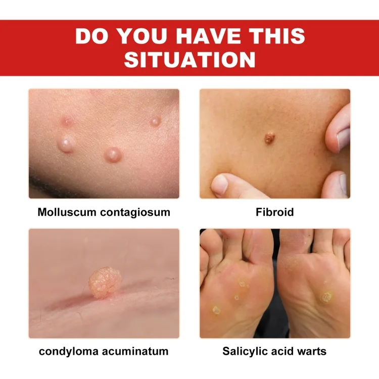 TBD06043397_3.webp Ximonth 20ml/Bottle Anti Mole And Wart Liquid Dark Spot Tag Remover Skin Essence - Image 4