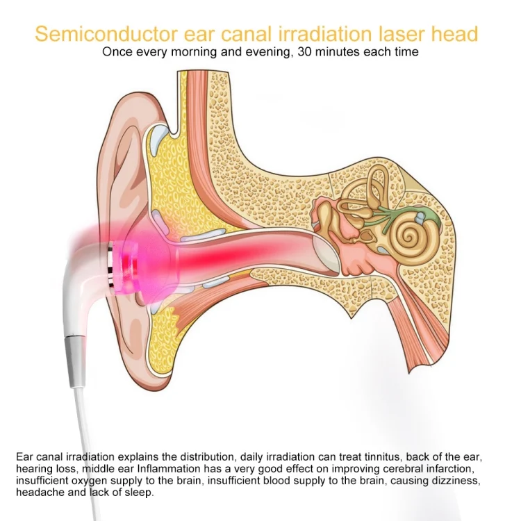 TBD06046316_5.webp 650nm Ear Laser Canal Irradiation Physiotherapy Instrument for Tympanitis Tinnitus Sudden Deafness - Image 6