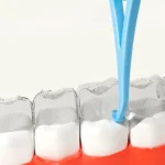 Fawnmum Braces Remover Invisible Orthodontic Removal Hook - Image 2